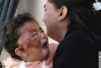 sebesült iraki gyerek